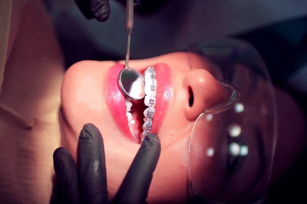Alineadores Dentales vs. Brackets: Explorando las ventajas de los alineadores dentales